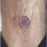 biopsy