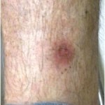 finaltreatment