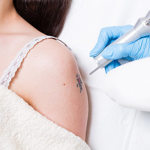 tattoo being removed with laser