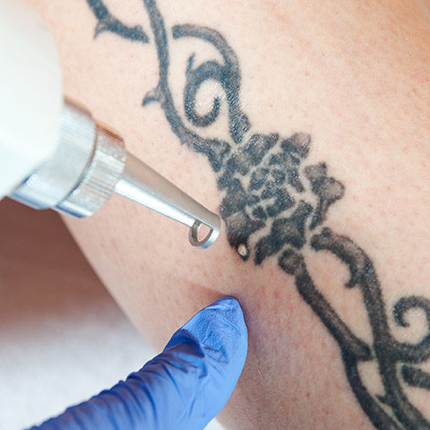 tattoo being removed with laser