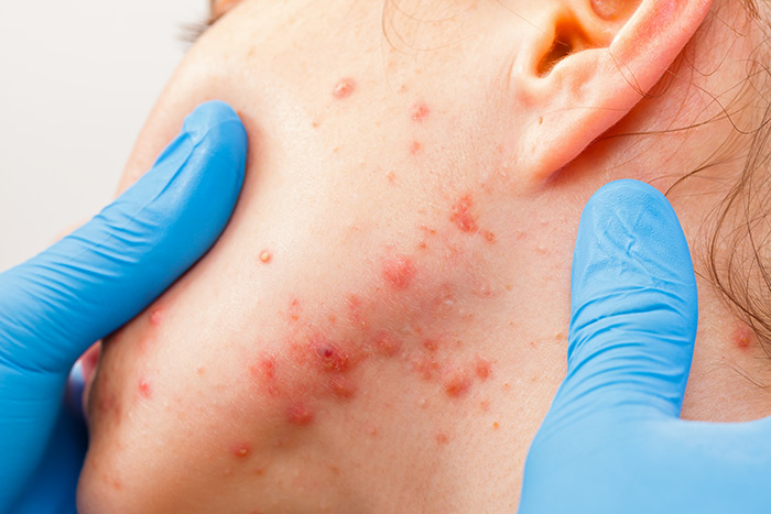 doctor examines the acne on the side of a female patient's face and neck