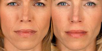 botox01