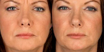 botox02
