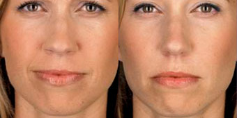 botox03